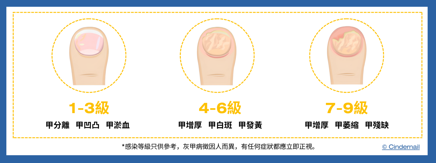 1064激光灰甲療程(10隻試做價)