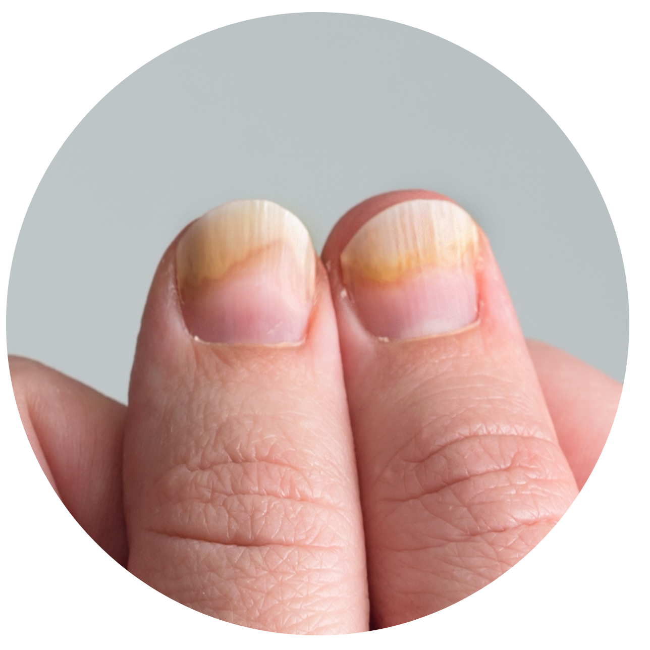 灰甲的成因及傳染途徑 – Cindernail•ASA Group International Limited