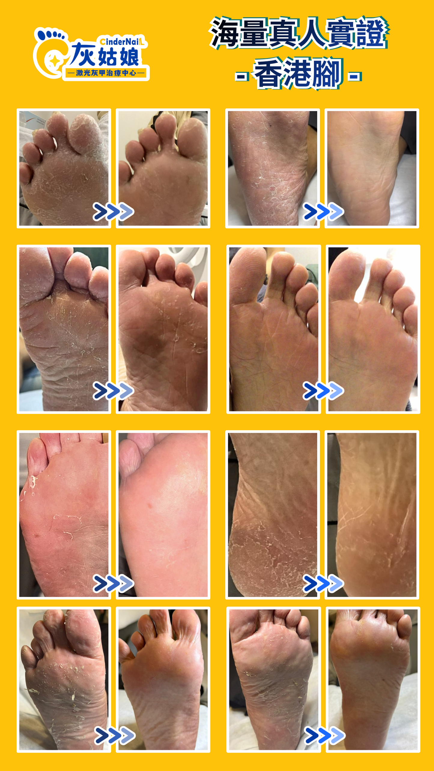 香港腳激光治療