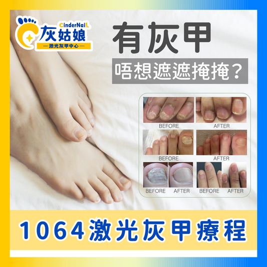1064激光灰甲療程(10隻試做價)