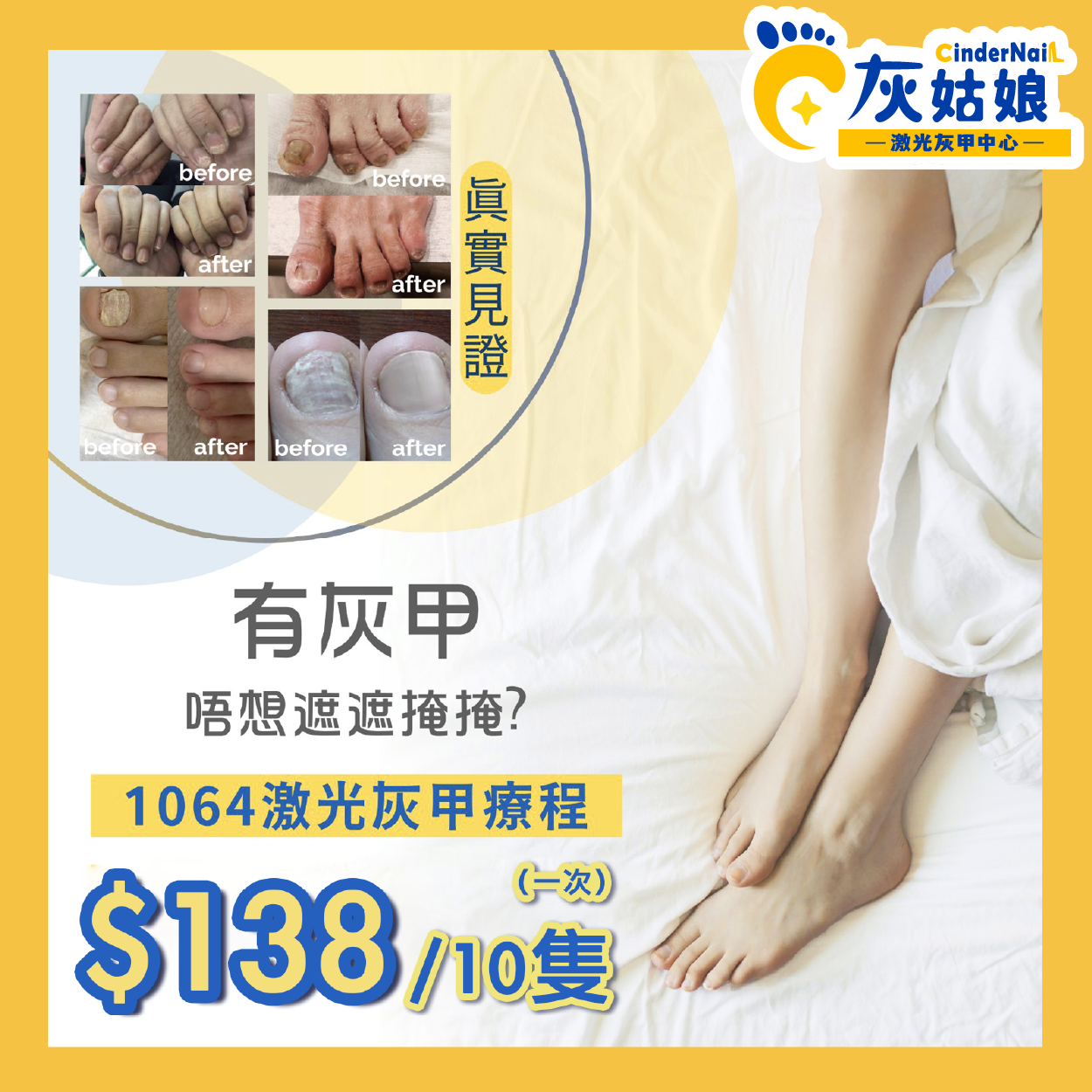 1064激光灰甲療程(10隻試做價)