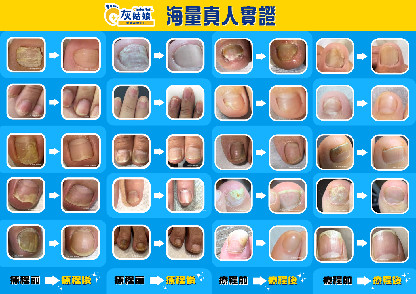 1064激光灰甲療程(10隻試做價)